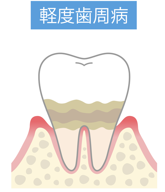 軽度歯周炎