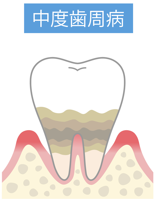 中等度歯周炎