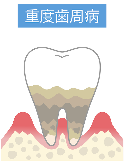 重度歯周炎