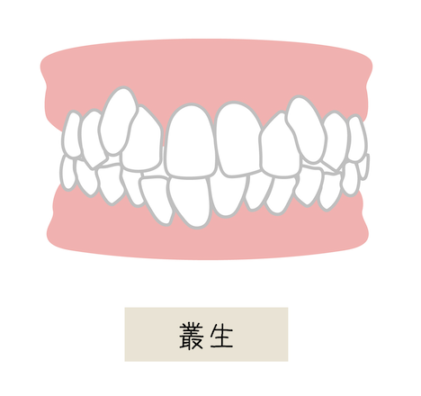 叢生（そうせい）・八重歯
