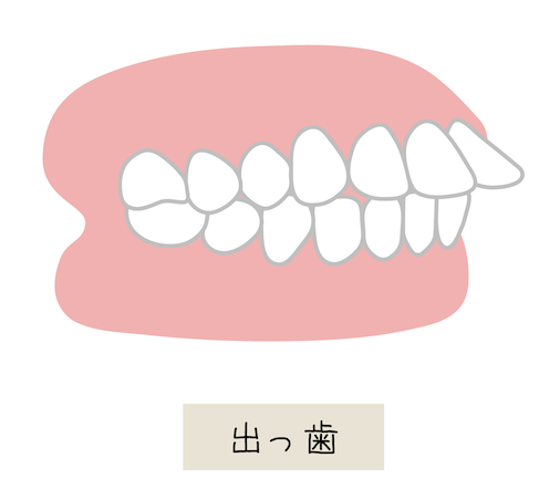 上顎前突（出っ歯）