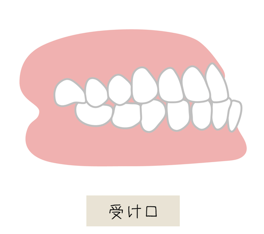 下顎前突（受け口）