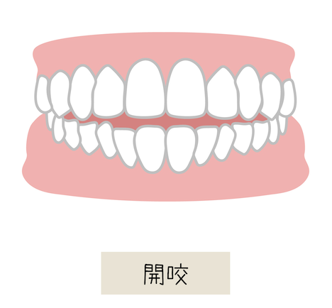 開咬（かいこう：オープンバイト）