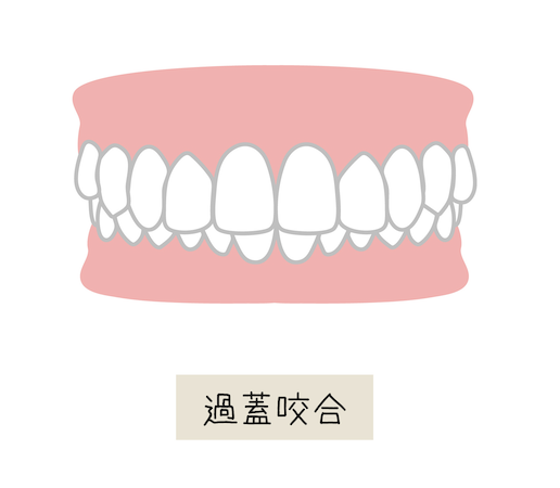 過蓋咬合（かがいこうごう：ディープバイト）