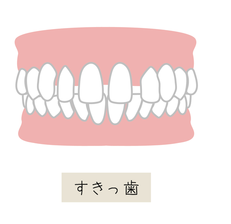 空隙歯列（すきっ歯）